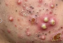 Cystic Acne Blackheads Extraction