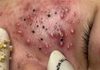 Cystic Acne Blackheads Extraction