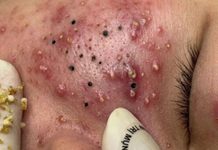 Cystic Acne Blackheads Extraction