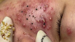 Cystic Acne Blackheads Extraction