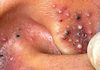 Blackheads Extraction