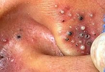 Blackheads Extraction