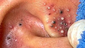 Blackheads Extraction