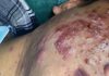 Cystic Acne Blackheads Extraction