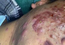 Cystic Acne Blackheads Extraction