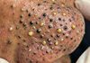 Cystic Blackheads Extraction