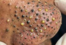Cystic Blackheads Extraction