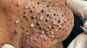 Cystic Blackheads Extraction