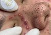 Cystic Blackheads Extraction