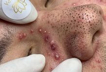 Cystic Blackheads Extraction