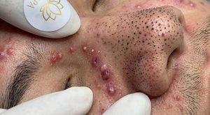 Cystic Blackheads Extraction