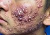 Acne Blackheads Extraction Whiteheads