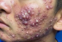 Acne Blackheads Extraction Whiteheads