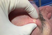 Extraction Whiteheads