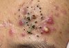Blackheads Extraction