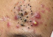Blackheads Extraction