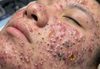 Cystic Acne Blackheads Extraction
