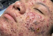 Cystic Acne Blackheads Extraction