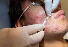 Acne Blackheads Extraction