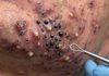 Acne Blackheads Extraction Removal