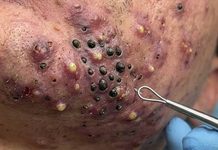 Acne Blackheads Extraction Removal