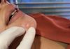 Blackheads Extraction