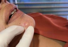 Blackheads Extraction