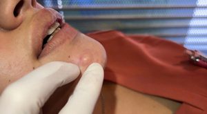 Blackheads Extraction