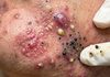 Acne Blackheads Extraction Whiteheads