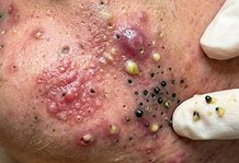 Acne Blackheads Extraction Whiteheads