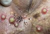 Cystic Blackheads Extraction Whiteheads
