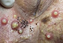 Cystic Blackheads Extraction Whiteheads