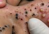 Cystic Blackheads Extraction
