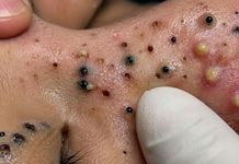 Cystic Blackheads Extraction