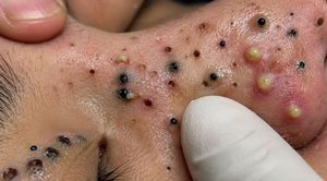 Cystic Blackheads Extraction