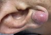 Big Cystic Blackheads Extraction