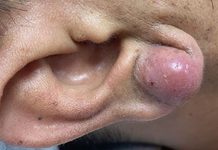 Big Cystic Blackheads Extraction